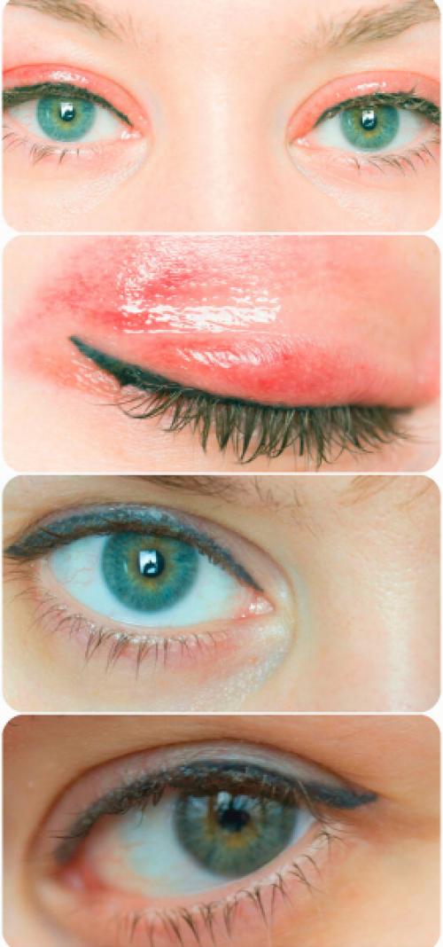 Неудачный межресничный татуаж. Неудачный татуаж межресничного пространства/Что делать ?