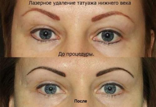 Неудачный межресничный татуаж. Неудачный татуаж межресничного пространства/Что делать ?