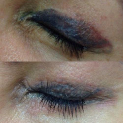 Неудачный межресничный татуаж. Неудачный татуаж межресничного пространства/Что делать ?