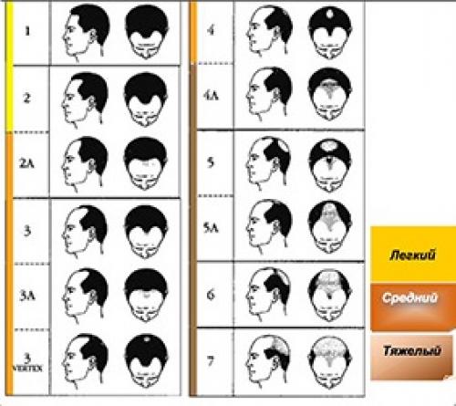 Средство для роста волос для мужчин. Зоны и стадии облысения при мужской алопеции