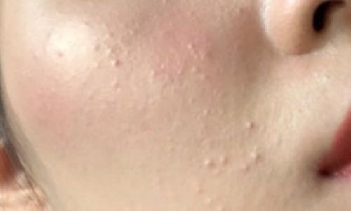 Как ухаживать за кожей с комедонами. Причины появления акне 02