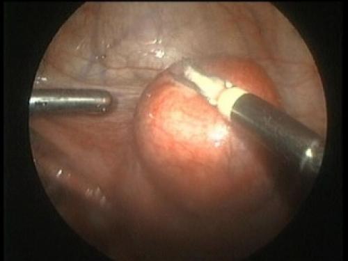 Подготовка к операции по удалению миомы матки. Оперативное лечение миомы матки. 01 Подготовка к операции по удалению миомы матки. Оперативное лечение миомы матки. 01