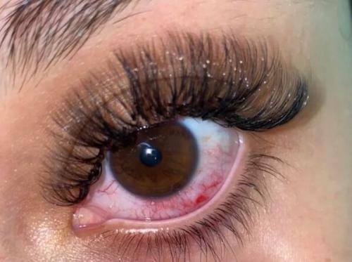 Красные глаза после наращивания ресниц. Причины покраснения глаз после наращивания 12 Красные глаза после наращивания ресниц. Причины покраснения глаз после наращивания 12