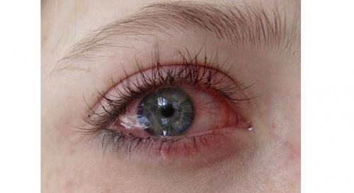 Красные глаза после наращивания ресниц. Причины покраснения глаз после наращивания 02 Красные глаза после наращивания ресниц. Причины покраснения глаз после наращивания 02