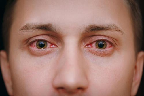 Как устранить аллергическую реакцию на глазах. Патогенез