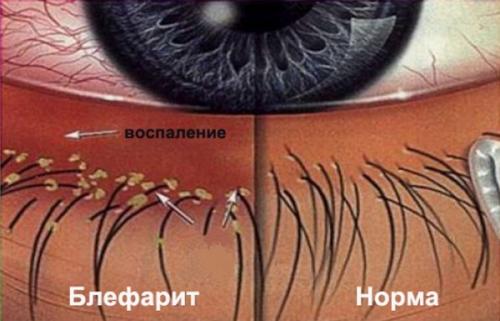 Как справиться с выпадением верхних ресниц 01 Как справиться с выпадением верхних ресниц 01