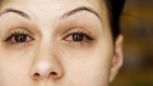 Химический ожог глаза после наращивания ресниц. Какие капли при ожоге глаз может назначить врач? 04 Химический ожог глаза после наращивания ресниц. Какие капли при ожоге глаз может назначить врач? 04