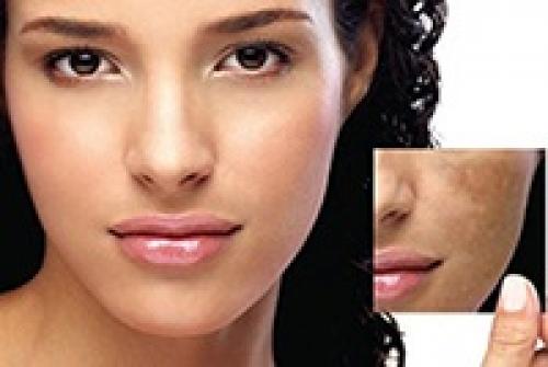 Как убрать возрастные пигментные пятна. Гиперпигментация: из-за чего возникают возрастные пигментные пятна и как их можно уменьшить 04