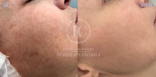 Печеночные пятна на лице. Пигментация и гипер-пигментация на лице, руках, декольте. Пигментные пятна.