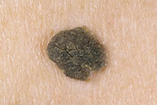 Как убрать возрастные пигментные пятна. Гиперпигментация: из-за чего возникают возрастные пигментные пятна и как их можно уменьшить 05