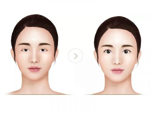 Какие способы коррекции формы глаз подойдут для узкоглазых. Можно ли изменить разрез глаз