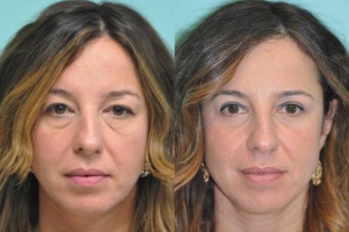 Ламинирование ресниц после наращивания: плюсы и минусы 01 Ламинирование ресниц после наращивания: плюсы и минусы 01