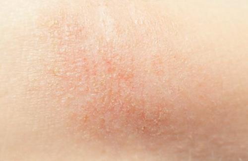 Атопический дерматит лечение у взрослых. Что такое атопический дерматит?