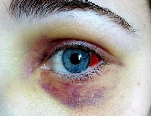 Первая помощь при травме глаза. Поверхностные травмы глаз 04 Первая помощь при травме глаза. Поверхностные травмы глаз 04