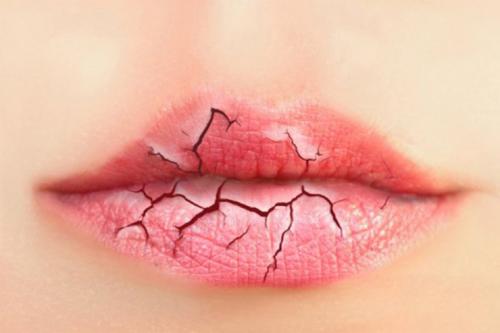 Почему губы трескаются и шелушатся. Виды хейлита 01 Почему губы трескаются и шелушатся. Виды хейлита 01