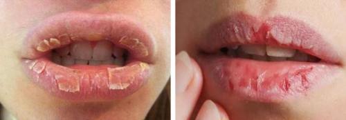 Почему губы трескаются и шелушатся. Виды хейлита 02 Почему губы трескаются и шелушатся. Виды хейлита 02