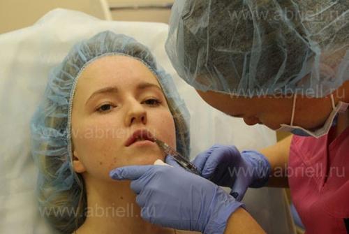 Увеличение губ гиалуроновой кислотой. Этапы процедуры увеличение губ гиалуроновой кислотой 04 Увеличение губ гиалуроновой кислотой. Этапы процедуры увеличение губ гиалуроновой кислотой 04