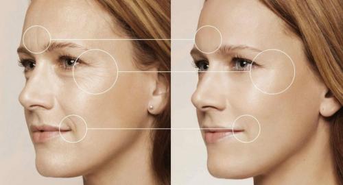 В чем отличие скульптора для лица от других методов коррекции овала лица, например, контурной пластики. Что такое контурная коррекция лица