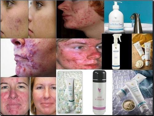 Лечение акне и алоэ Вера форевер. 02 Лечение акне и алоэ Вера форевер. 02