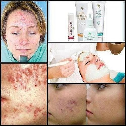 Лечение акне и алоэ Вера форевер. 04 Лечение акне и алоэ Вера форевер. 04