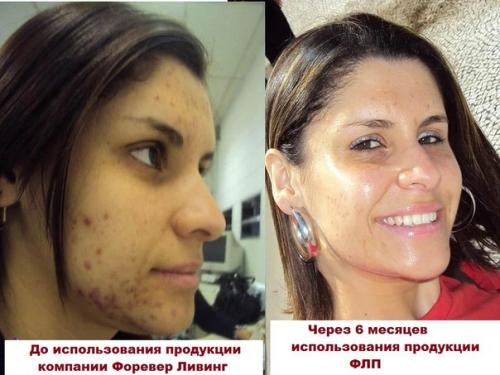 Лечение акне и алоэ Вера форевер. 03 Лечение акне и алоэ Вера форевер. 03