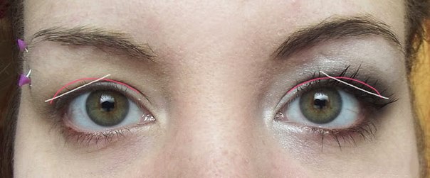 Коррекция нависшего века. 01