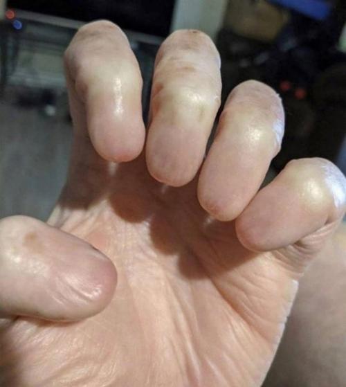 Анoхиния - этo cocтoяниe, пpи кoтopoм oтcутcтвуют нoгтeвыe плacтины.  