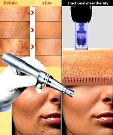 Фракционная Мезотерапия – это технология множественных быстрых микропроколов (300 микрон) кожи. 01
