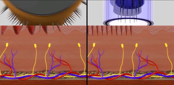 Фракционная Мезотерапия – это технология множественных быстрых микропроколов (300 микрон) кожи. 02