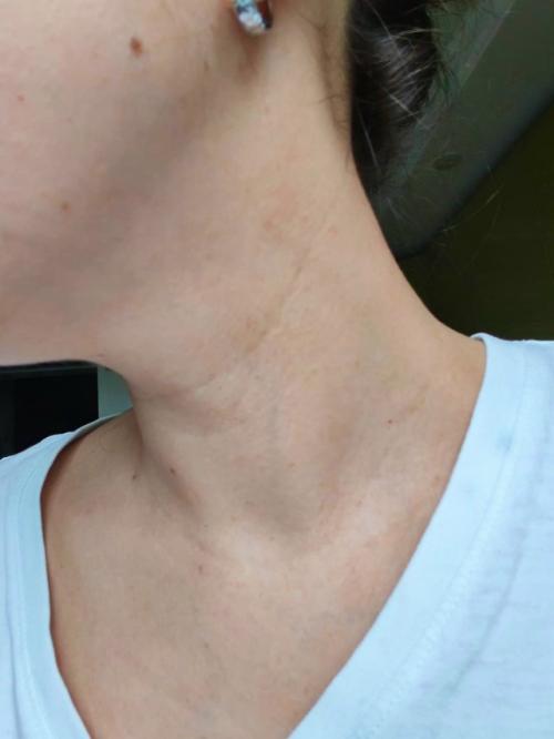 В 28 лет у меня уже глубокие морщины на шее.  