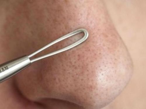 Устранение черных точек в домашних условиях. 02