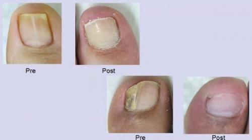 Удаление неудачного татуажа, вросшего ногтя и д. р? 04