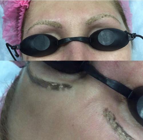 Удаление неудачного татуажа, вросшего ногтя и д. р? 02