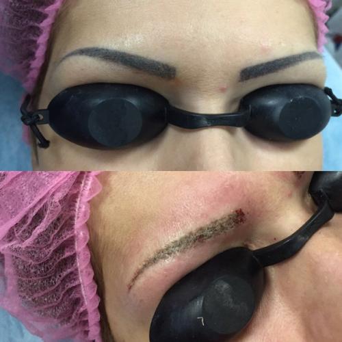 Удаление неудачного татуажа, вросшего ногтя и д. р? 03