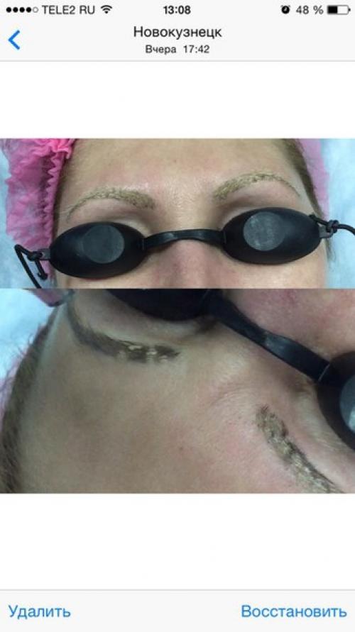 Удаление неудачного татуажа, вросшего ногтя и д. р? 01