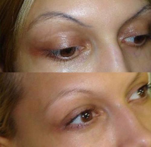 Удаление неудачного татуажа, вросшего ногтя и д. р? 05