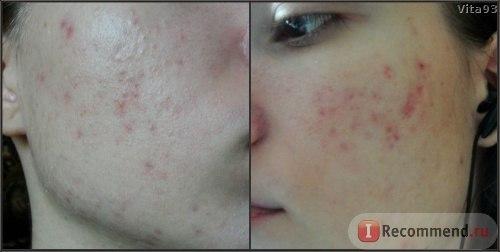 В наличии!  Это нереально эффективный крем! 100. 01