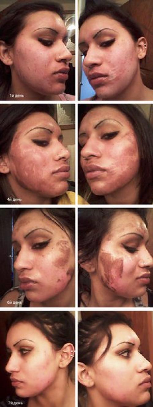 Тса - пилинг.  Тса пилинг и все, что о нем нужно знать. 03