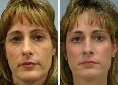 Тса - пилинг.  Тса пилинг и все, что о нем нужно знать. 08