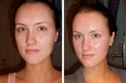 Тса - пилинг.  Тса пилинг и все, что о нем нужно знать. 04