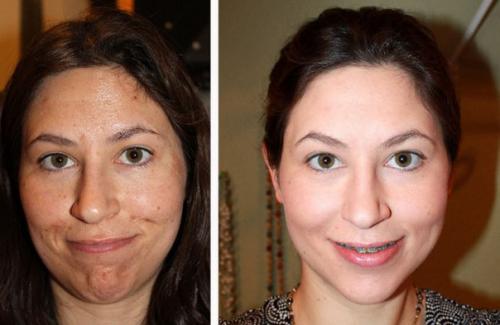 Тса - пилинг.  Тса пилинг и все, что о нем нужно знать. 06