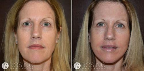 Тса - пилинг.  Тса пилинг и все, что о нем нужно знать. 02