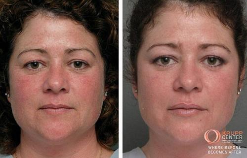 Тса - пилинг.  Тса пилинг и все, что о нем нужно знать. 07