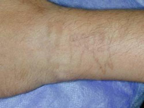 Наш неодимовый лазер для удаления та ту и татуажа! 02