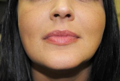 Как избавиться от носогубных складок. 01