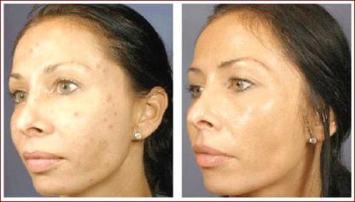 Порошкообразный абразивный пилинг от Anna Lotan для отшелушивания верхнего слоя эпидермиса. Пилинг грин марин Анна Лотан