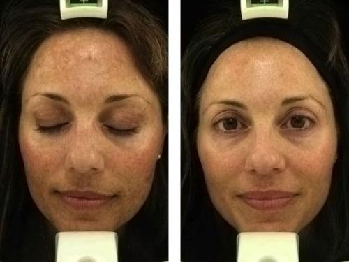 Порошкообразный абразивный пилинг от Anna Lotan для отшелушивания верхнего слоя эпидермиса. Пилинг грин марин Анна Лотан