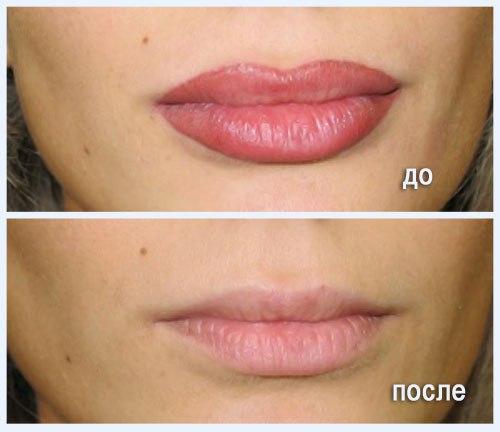 Внимание!  Вы хотите избавиться от неудавшегося перманентного макияжа? 03 Внимание!  Вы хотите избавиться от неудавшегося перманентного макияжа? 03