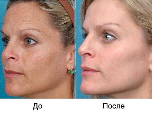 Как избавиться от пигментных пятен? 01 Как избавиться от пигментных пятен? 01