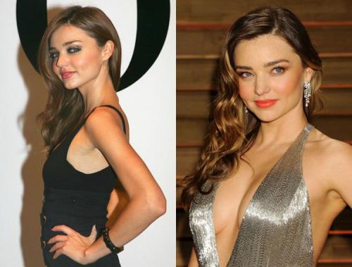 Что скрывать: звезды до и после пластики. 01